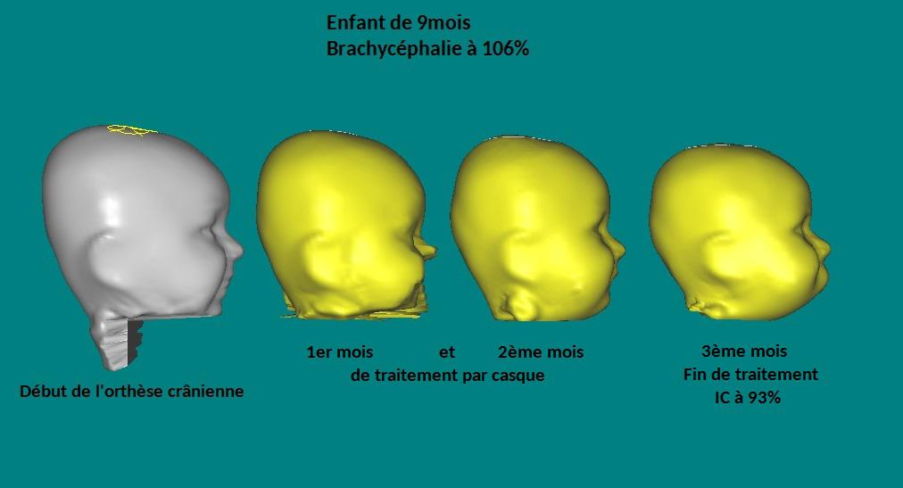 Les R sultats Du Traitement Par Orth se Cr nienne B b T te Plate