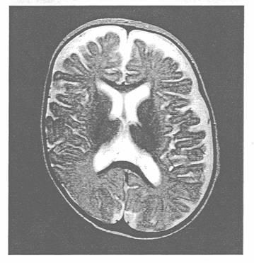 IRM d’un cerveau atteint de plagiocéphalie.